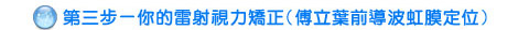 第3步：您的雷射視力矯正(立葉前導波虹膜定位)